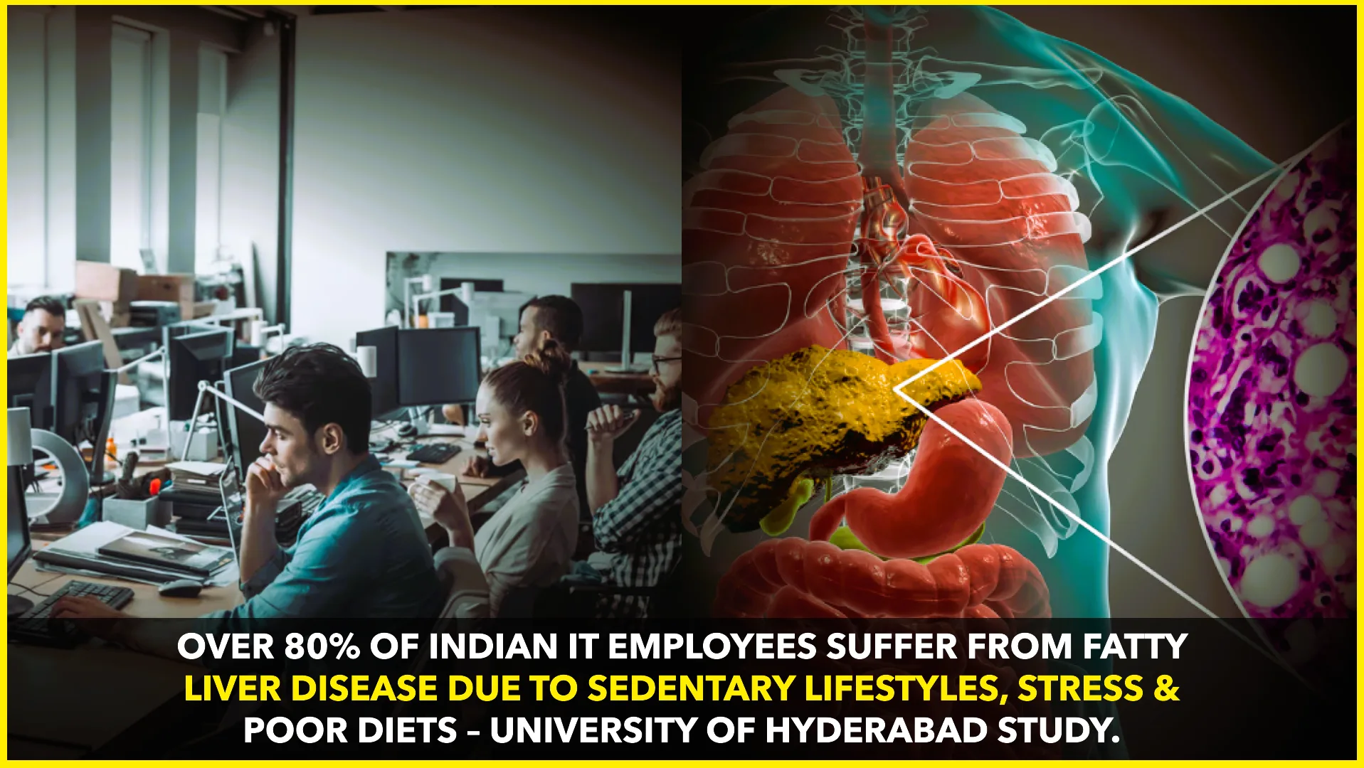 Over 80% of Indian IT Employees Suffer from Fatty Liver Disease: University of Hyderabad Study