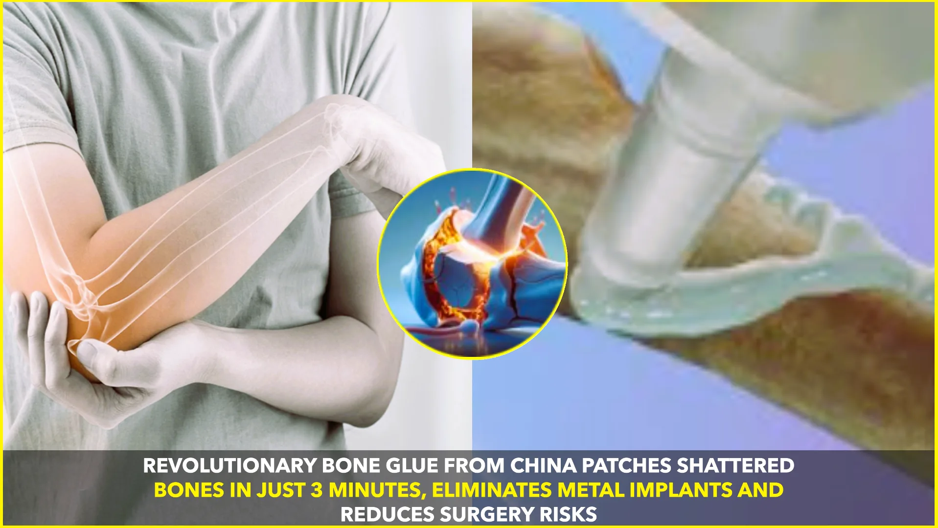 Revolutionary “Bone Glue” Bonds Shattered Bones in Minutes